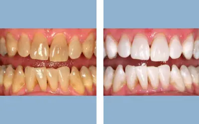 Before and After